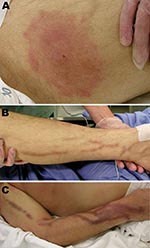  Lesions of the patient infected with Babesia divergens 1 day after hospitalization, Finland, 2004. A) Left thigh showing a classical erythema chronicum migrans lesion; B) left leg and C) right arm