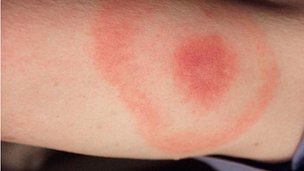 lyme disease - erythema migrans picture